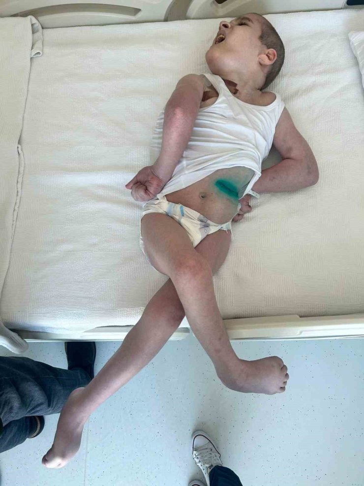 RUSYA’DA ÇARESİZ KALAN ÇOCUĞA TÜRK DOKTORLARDAN UMUT VEREN TEDAVİ